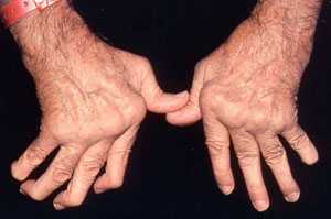 Rheumatoid_Arthritis